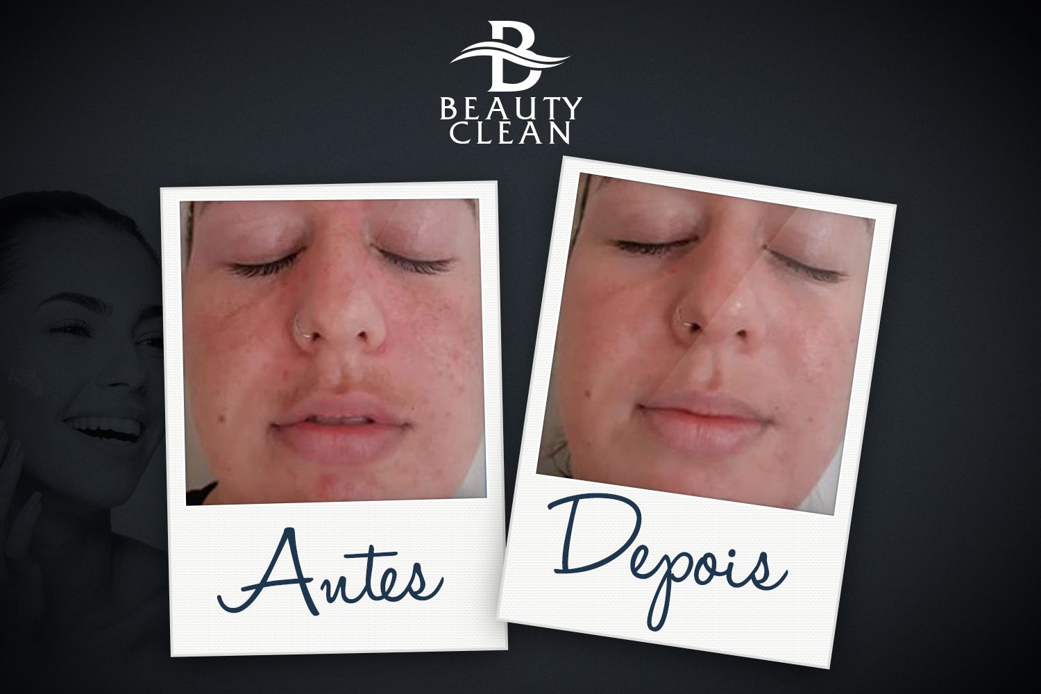 Imagem relacionada a Beauty Clean funciona contra manchas e melasma? [Review]