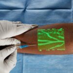 Imagem relacionada a Novos dispositivos ajudam na identificação de vasos sanguíneos subcutâneos